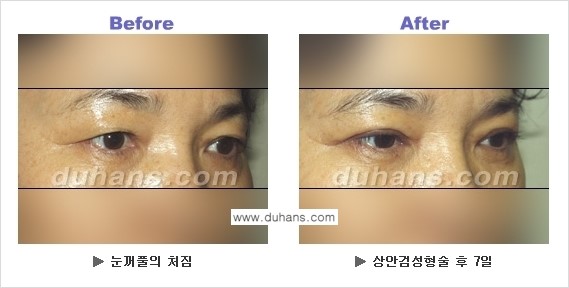 [두한성형외과 NO.1 눈성형] - [상안검 수술에 대한 정보] 관련 이미지 5