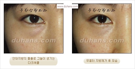⁠⁠[두한성형외과 경쟁력 안검성형] - [젊은 눈매를 위한 윗눈꺼풀 지방제거, 눈밑 지방제거] 관련 이미지 38