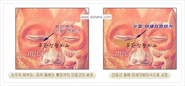 [두한성형외과 경쟁력 눈밑성형] - [눈밑 다크써클, 눈밑 주름의 교정 안내 1.] 관련 이미지 7