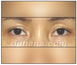 Candidates for Double Eyelid Revision Surgery: Unattractive Double Eyelids, Beautiful Double Eyelids image 13