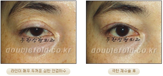 [DoubleFold Plastic Surgery Eye Surgery] - [Revision Surgery for Thick Double Eyelids] image 41