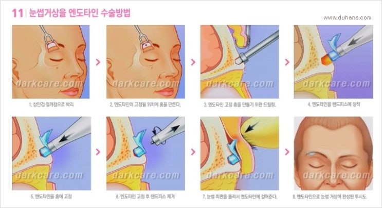 [두한성형외과 경쟁력 다크써클 치료] - [다크써클 + 엔도타인 리프팅 콤비 프로그램] 관련 이미지 12