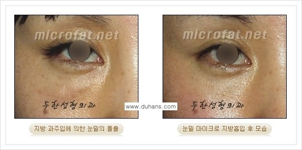 [두한성형외과 겨울엔 지방흡입을] - [볼살, 눈밑, 턱선의 초음파 미세지방흡입 2.] 관련 이미지 4