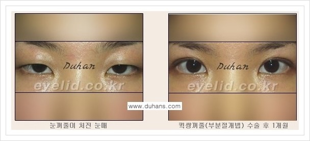 [두한성형외과 경쟁력 쌍꺼풀 재수술, 극한 재수술] - [쌍꺼풀 수술 관련 질문과 답변] 관련 이미지 3
