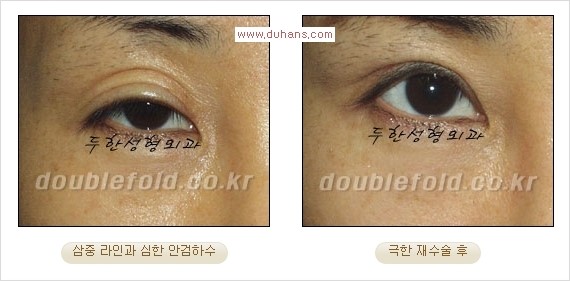 [두한성형외과 경쟁력 쌍꺼풀 재수술] - [피부 여유분이 부족해서 토안증이 발생한 경우 극한 재수술] 관련 이미지 4