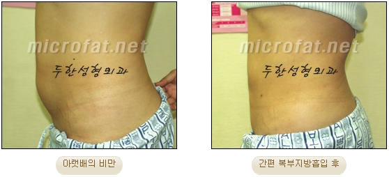 두한성형외과 지방흡입 - 부위별 안전 지방흡입 관련 이미지 15