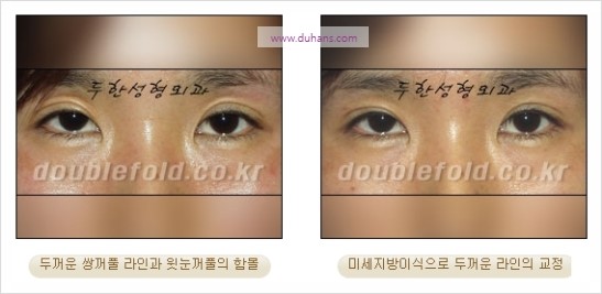 [두한성형외과 경쟁력 눈성형] - [쌍꺼풀 재수술 과정과 쌍꺼풀 재수술 실패의 원인, 쌍꺼풀 재수술의 성공 요건] 관련 이미지 28