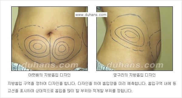 [두한성형외과 성형 FOCUS 간편 지방흡입] - [비만 탈출! 초음파 지방흡입 ②] 관련 이미지 3