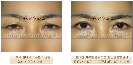 쌍꺼풀수술 두한성형외과 - 쌍커풀재수술의 문제점 관련 이미지 8