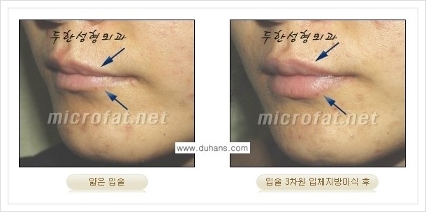 [두한성형외과 경쟁력 미세지방이식] - [입술 미세지방이식 안내 2.] 관련 이미지 12