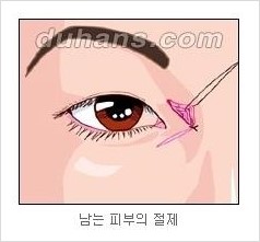 [두한성형외과 경쟁력 눈성형] - [흉터없는 몽고주름 제거술(앞트임) 관련 이미지 10