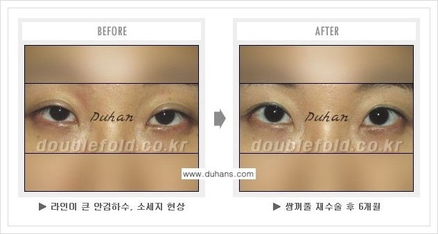 [두한성형외과 경쟁력 쌍꺼풀 재수술, 극한 눈재수술] - [과교정 된 눈매교정] 관련 이미지 2