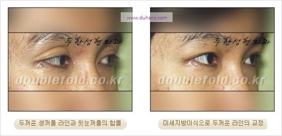 [두한성형외과 경쟁력 눈성형] - [쌍꺼풀 재수술 과정과 쌍꺼풀 재수술 실패의 원인, 쌍꺼풀 재수술의 성공 요건] 관련 이미지 29