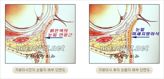 [두한성형외과 경쟁력 눈밑성형 리더] - [윗눈꺼풀 지방제거, 눈밑지방제거, 눈밑지방재배치, 눈밑지방이식 안내] 관련 이미지 15