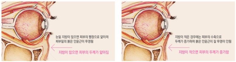 두한성형외과 눈밑수술 - 다크서클 수술 전후 관리 안내 관련 이미지 38
