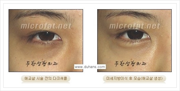[두한성형외과 경쟁력 눈밑성형] - [눈밑 애교살 미세지방이식 안내] 관련 이미지 14