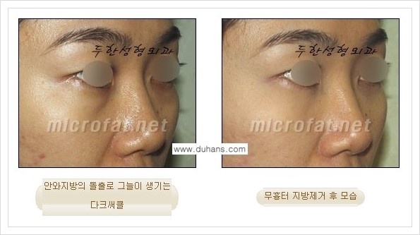 [두한성형외과 경쟁력 눈밑성형] - [눈밑지방제거, 눈위지방제거 안내 2.] 관련 이미지 2