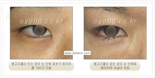 [두한성형외과 경쟁력 맞춤 눈성형] - [눈성형에 관한 자주하는 질문과 답변 안내] 관련 이미지 17