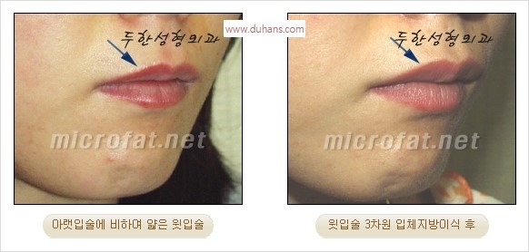 ​​[두한성형외과 경쟁력 미세지방이식] - [볼륨감 있는 입술성형] 관련 이미지 15