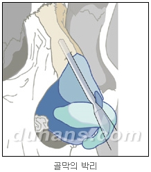 [두한성형외과 코성형] - [코재수술 방법] 관련 이미지 22