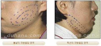 [두한성형외과 안전한 지방흡입] - [얼굴지방흡입] 관련 이미지 6