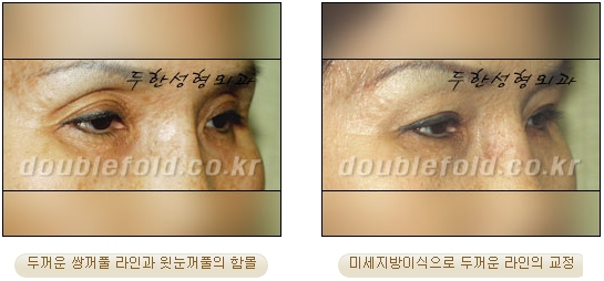 [두한성형외과 눈재수술] - [지방이식과 쌍꺼풀재수술 동시에 하는 경우] 관련 이미지 15