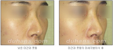 [두한성형외과 코재수술] - [코성형 안내] 관련 이미지 7