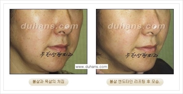 [두한성형외과 경쟁력 주름성형] - [엔도타인 리프팅 안내 ②] 관련 이미지 2