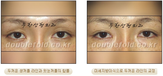 [Eye Reoperation Duhan Plastic Surgery] - [Guide to Double Eyelid Revision Surgery] image 46