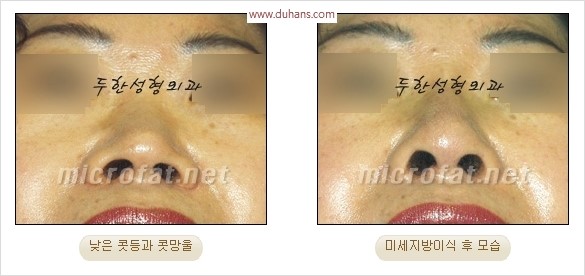 [두한성형외과 경쟁력 코성형 리더] - [자연스럽고 오똑한 콧망울! 코성형 방법]​ 관련 이미지 54