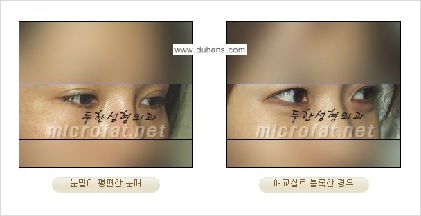 [두한성형외과 경쟁력 눈밑성형] - [눈밑 애교살 시술 안내 1.] 관련 이미지 1