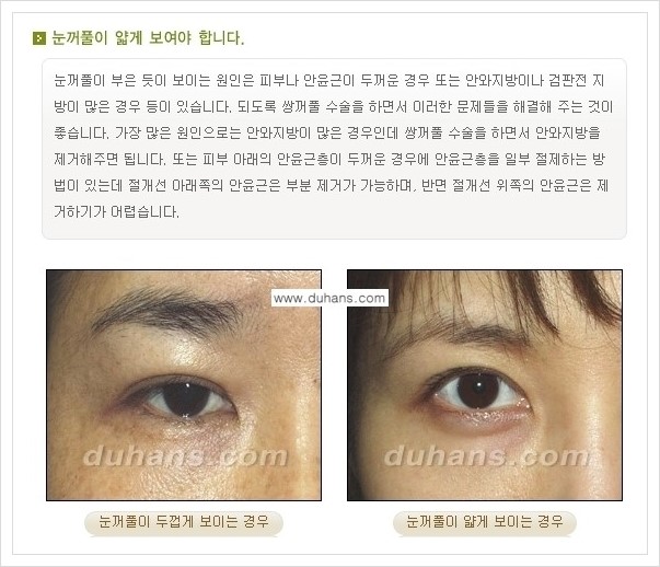 [두한성형외과 경쟁력 눈성형] - [아름답고 자연스러운 눈매, 매력적인 쌍꺼풀 안내] 관련 이미지 4