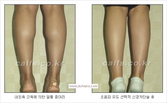 ⁠[두한성형외과 경쟁력 종아리성형] - [종아리퇴축술 - 비절개 초음파 유도 선택적 신경차단술 장비 안내] 관련 이미지 13