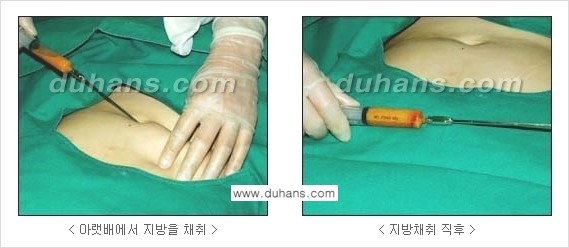 [두한성형외과 경쟁력 미세지방이식] - [다크써클 & 눈밑주름 미세지방이식 2.] 관련 이미지 3