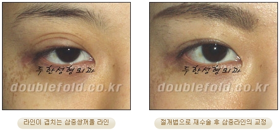 두한성형외과 쌍커풀재수술 - 삼중 쌍커풀 라인 교정 관련 이미지 27