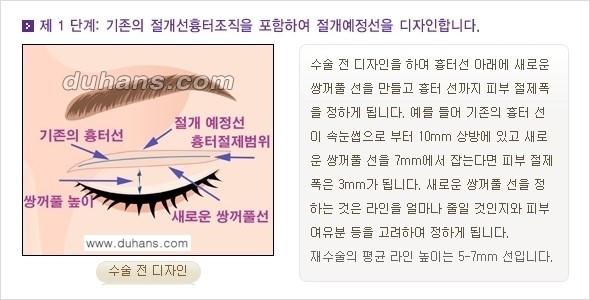 [두한성형외과 경쟁력 눈성형] - [쌍꺼풀 재수술 방법 - 완전절개법(Full incision method) 과정 안내] 관련 이미지 2