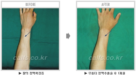[종아리성형 두한성형외과] - [종아리수술에 대한 자주하는 질문과 답변 모음] 관련 이미지 36