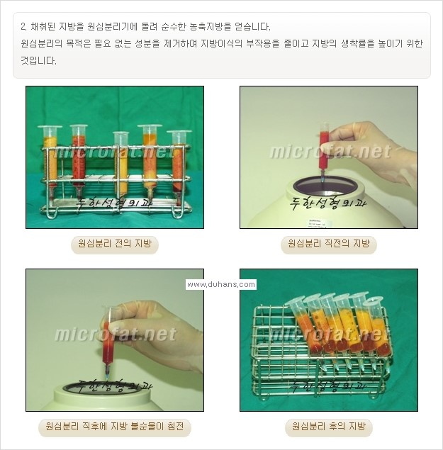 [두한성형외과 경쟁력 미세지방이식] - [타 병원에서 볼살 지방이식 이후 부작용 교정 방법 안내] 관련 이미지 20