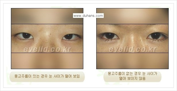 [두한성형외과 경쟁력 눈성형] - [흉터없는 몽고주름 제거 - 앞트임 수술] 관련 이미지 2
