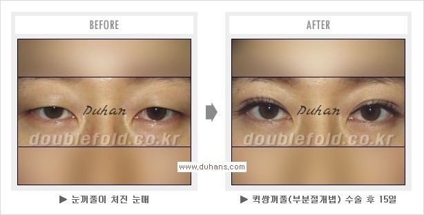 ​[두한성형외과 경쟁력 눈성형] - [퀵쌍꺼풀(부분절개법) 수술 관련 자주하는 질문과 답변] 관련 이미지 5