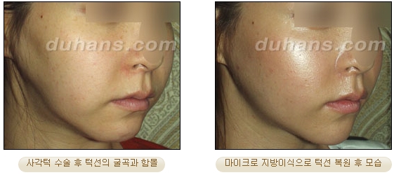 [두한성형외과 얼굴자가지방이식] - [볼살, 이마, 측두부] 관련 이미지 40