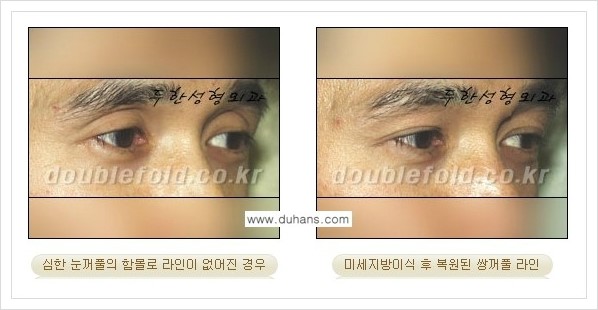 [두한성형외과 경쟁력 쌍꺼풀 재수술, 극한 재수술] - [미세지방이식으로 풀린 쌍꺼풀 교정] 관련 이미지 7