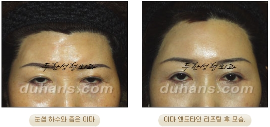 두한성형외과 안티에이징 리프팅 - 엔도타인 리프팅 관련 이미지 30