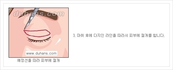 [두한성형외과 경쟁력 안검성형] - [상큼하고 환한 눈매의 완성 상안검 성형술 안내] 관련 이미지 3