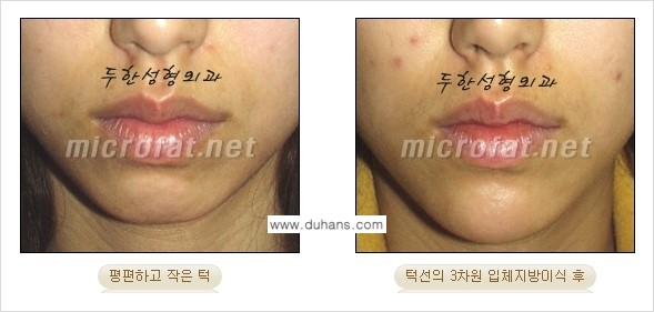 [두한성형외과의 경쟁력 미세지방이식] - [무턱교정 - 턱 미세지방이식 안내 2.] 관련 이미지 11