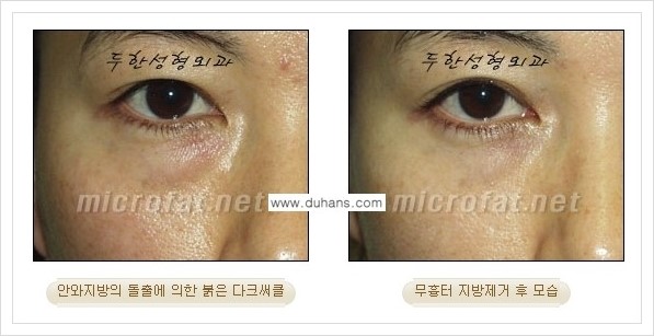 [두한성형외과 경쟁력 눈밑성형] - [눈밑지방제거, 눈위지방제거 안내 1.] 관련 이미지 26