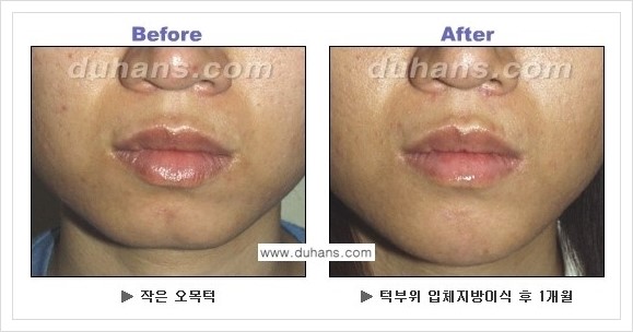 [두한성형외과 경쟁력 미세지방이식] - [아름다운 얼굴선 - 무턱, 오목턱, 비대칭턱 지방이식 안내] 관련 이미지 6