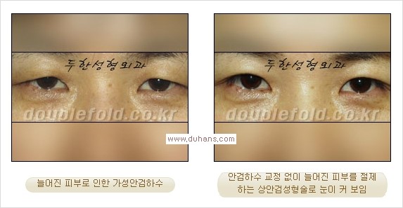 [두한성형외과 경쟁력 눈성형] - [안검하수(졸린눈매) 눈매교정 여러 가지 방법 안내] 관련 이미지 8
