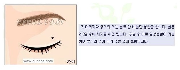 [두한성형외과 경쟁력 눈성형] - [윗눈꺼풀 지방제거 방법 안내] 관련 이미지 6