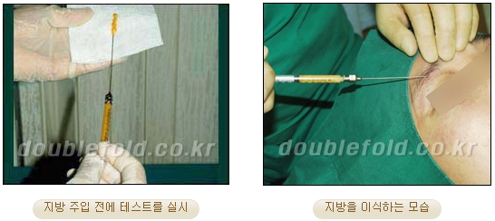 두한성형외과 쌍커풀재수술 - 삼중 쌍커풀 라인 교정 관련 이미지 32